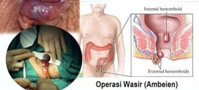 Cara Mengobati Ambeien Atau Wasir Secara Alami